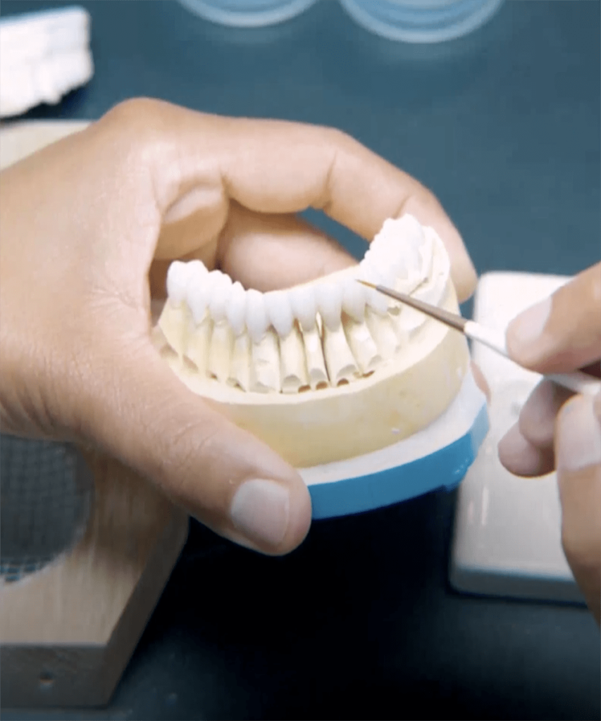 Before and after porcelain veneer smile makeover transformation by Beverly Hills cosmetic dentist Dr. Rodney Raanan celebrity dentist 411 Camden Drive