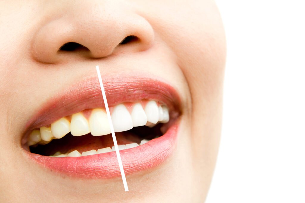 Woman's smile showcasing the benefits discussed in "Tips for Maintaining Porcelain Veneers