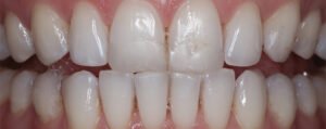 porcelain veneers for cracks