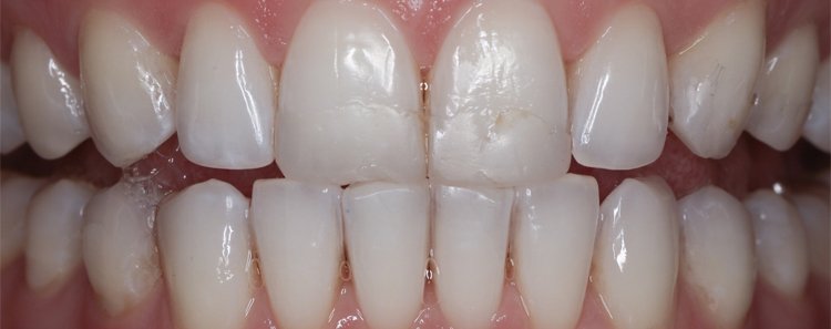 porcelain veneers for cracks