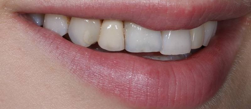 Porcelain Veneers Alignment and Symmetry