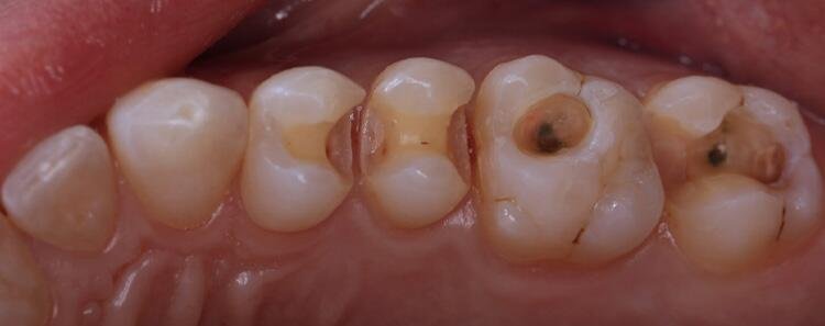 Tooth Fillings Beverly Hills