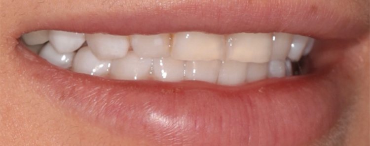 Correction of Discoloration