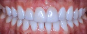 Smile Makeover using Porcelain Veneers