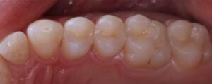 Tooth Fillings Beverly Hills