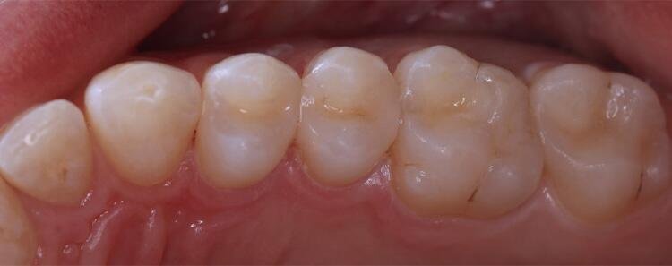 Tooth Fillings Beverly Hills