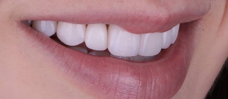 Porcelain Veneers Alignment and Symmetry