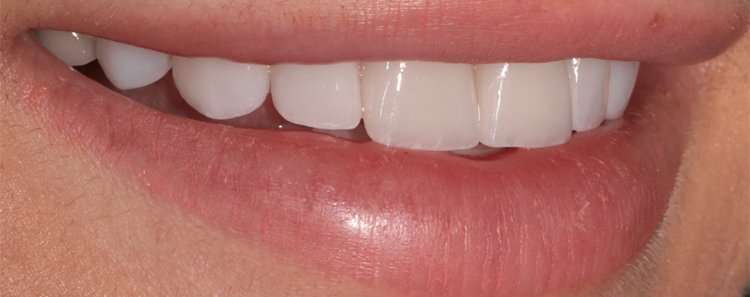 Correction of Discoloration
