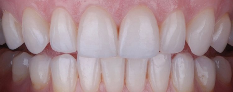 porcelain veneers for cracks
