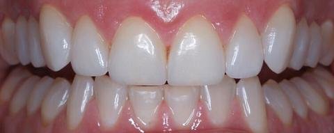 Full Coverage Crowns