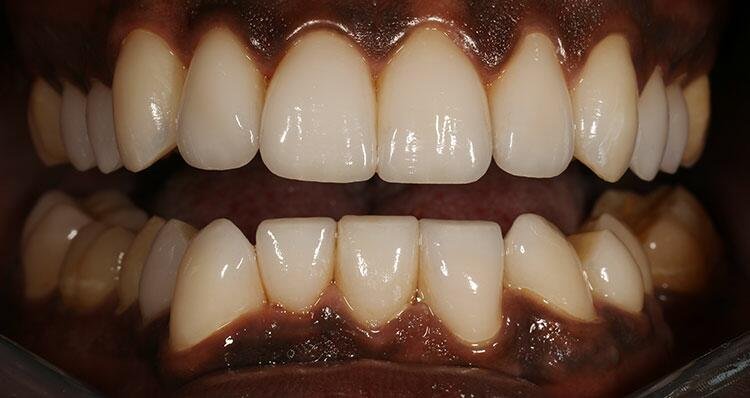 Full Coverage Crowns