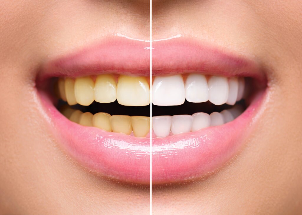 Hollywood teeth whitening